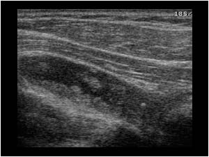 fluid and synovial thickening