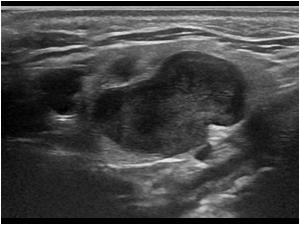 pleomorphic adenoma submandibular gland ultrasound)