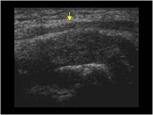 Synovial pannus displacing ulnar nerve longitudinal