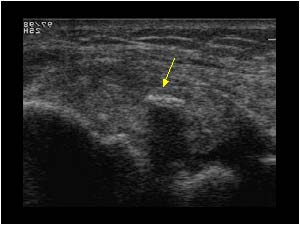 Collateral ligament longitudinal with bony fragment