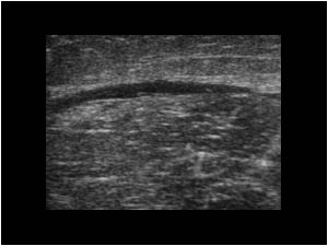 Transverse defect non visualization of the tendon