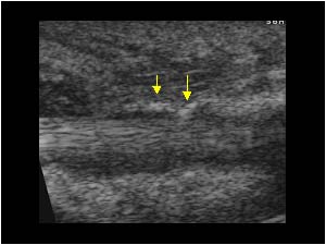 Fragments in the synovial sheath in the carpus