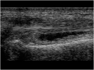 Longitudinal tenosynovitis of the extensor carpi ulnaris tendon