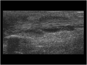 Longitudinal tenosynovitis of the extensor carpi ulnaris tendon