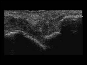 Ruptured extensor carpi ulnaris tendon longitudinal