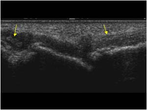 Ruptured extensor carpi ulnaris tendon longitudinal with proximal and distal stump