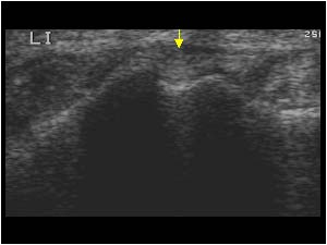 Transverse normal filled groove next to Listers tubercle