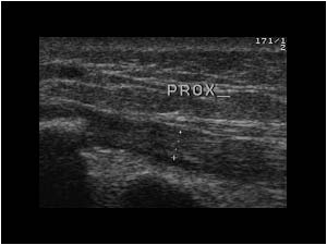 Proximal retracted tendon longitudinal