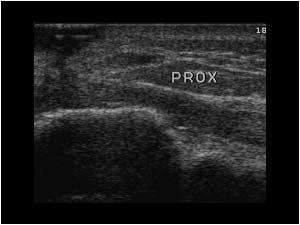 Proximal retracted tendon longitudinal