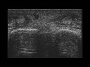 Digit 3 and 4 with synovial thickening transverse