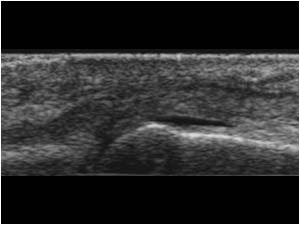 Digit 4 with synovial thickening longitudinal