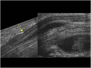 Nerve compression in the carpal tunnel caused by tenosynovitis of the flexor tendons longitudinal