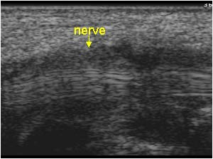 Median nerve and perineuritis and thickened tendons longitudinal