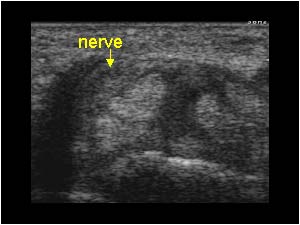Median nerve and thickened tendons transverse