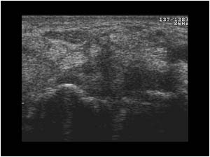 Synovial thickening in the carpal tunnel transverse