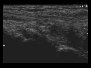 Synovial thickening and small calcifications dorsal side of the carpus