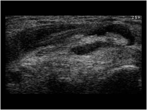 Thickened extensor pollicis longus tendon with synovial fluid at the intersection