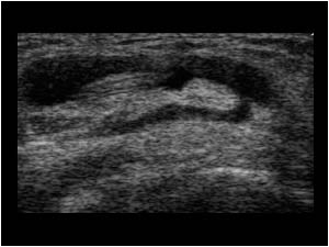 Thickened extensor pollicis longus tendon with synovial fluid at the intersection