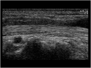 Thickened extensor pollicis longus tendon with synovial fluid at the intersection longitudinal