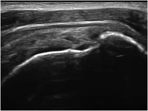 This is a longitudinal image of the supraspinatus tendon of another patient. It is not always possible to determine the exact extent of a tendon rupture. There is a partial rupture and volume loss and bursal thickening 