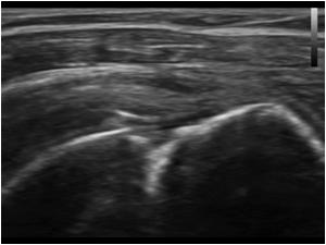 The tendon shows volume loss and the bursa is thickened. But the tendon is still intact