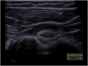 Another transverse image of the bicipital groove