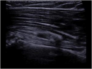 Longitudinal image of the biceps tendon