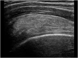 This is another patient with calcifications anterior of the biceps tendon