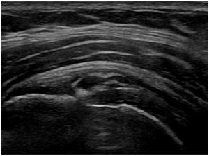 Longitudinal image of a calcific tendinitis in the resorbing phase don,t mistake this for a tendon rupture