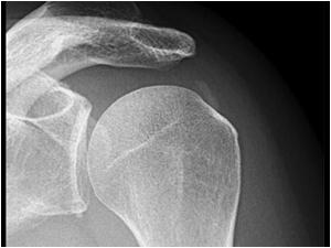 This is the X ray of the shoulder of the same patient