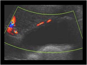 Cholecystitis with thickened gallbladder wall