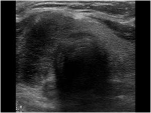 Transverse image of the nodule of the first patient. It is hypoechoic and ill defined