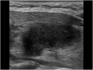 Longitudinal image of the nodule of the first patient
