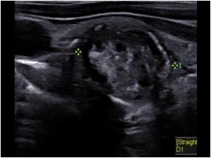 Longitudinal image of the nodule of the second patient