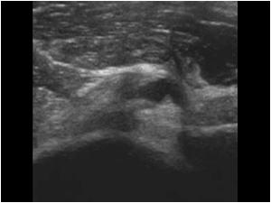 Transverse image of the patient with labral cysts