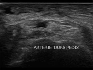 Transverse image of the dorsalis pedis artery without the mass