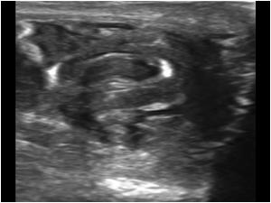 Another image of the same varicocele