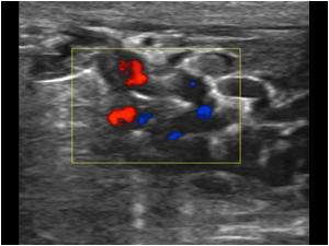 With color doppler there is only minimal flow along the thrombi in the varicose veins.