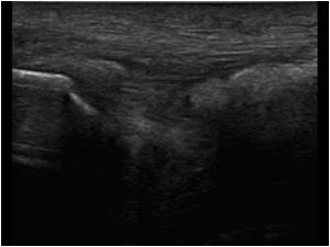 This patient has an abnormal patellar tendon.
What could be the cause?
A. CPPD
B. Gout
C. R.A.
D. Tendinosis