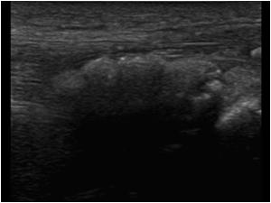 Another longitudinal image of the abnormal patellar tendon