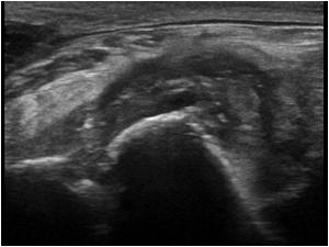 This is a longitudinal image of the same patient with synovial swelling and a bony erosion