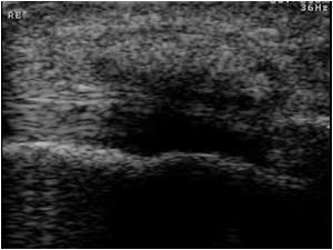 This is an image of the superficial calcaneal bursa filled with echogenic material in a patient with gout