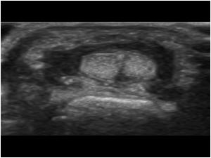 Transverse image of the same patient with synovial thickening with tiny calcifications