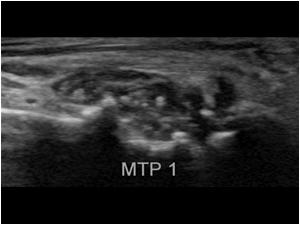 This is an image of the first metatarsophalangeal joint in a patient with gout with  synovial thickening with tiny calcifications 