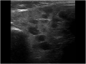 Transverse image of an abnormal thyroid gland