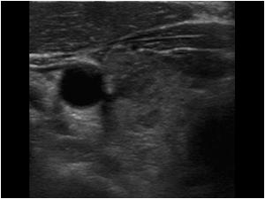 Transverse image of the diffuse inhomogeneous right thyroid lobe