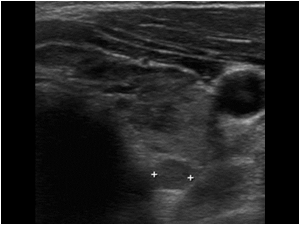 Transverse image of the left thyroid lobe. There is a small round structure in the parathyroid region