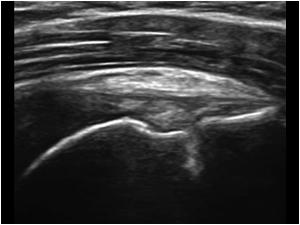 Thinning of the supraspinatus tendon and bursal thickening indicating a partial rupture