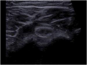 Resorbing calcifications in the bursa anterior of the biceps tendon