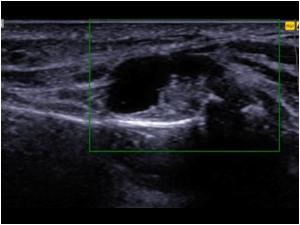 Cyst with some synovial proliferations